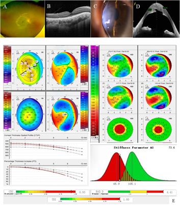 Exome sequencing confirms the clinical diagnosis of both joubert syndrome and klinefelter syndrome with keratoconus in a han Chinese family